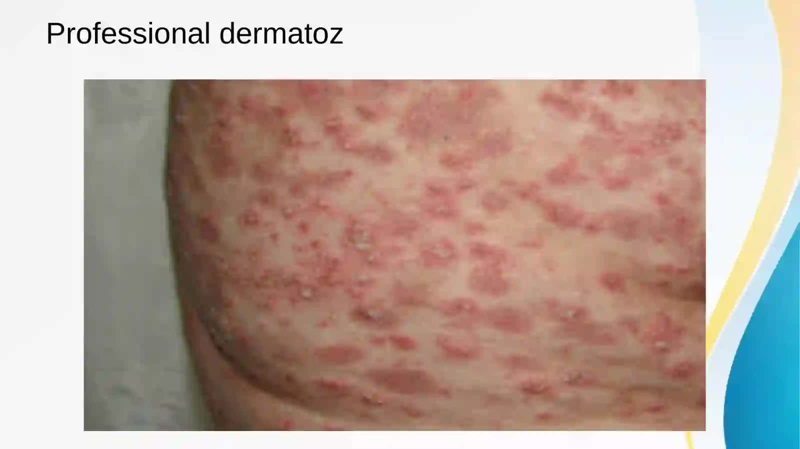 Professionaldermatozlar.Parapsoriaz.Psoriazvaboshqadermatozlardadavolashdakvant(PUVA,lazeroterapiya)zamonaviyasoslari 4