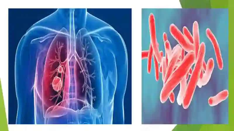 SOXTA SIL (Psevdotuberkulyoz) etiologiyasi, patogenezi va davolash 4