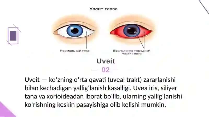 Mavzu:Uveit. Katarakta. Retinopatiyalar. To'r parda o'smalari. Ko'ruv nerv patologiyaları. 4
