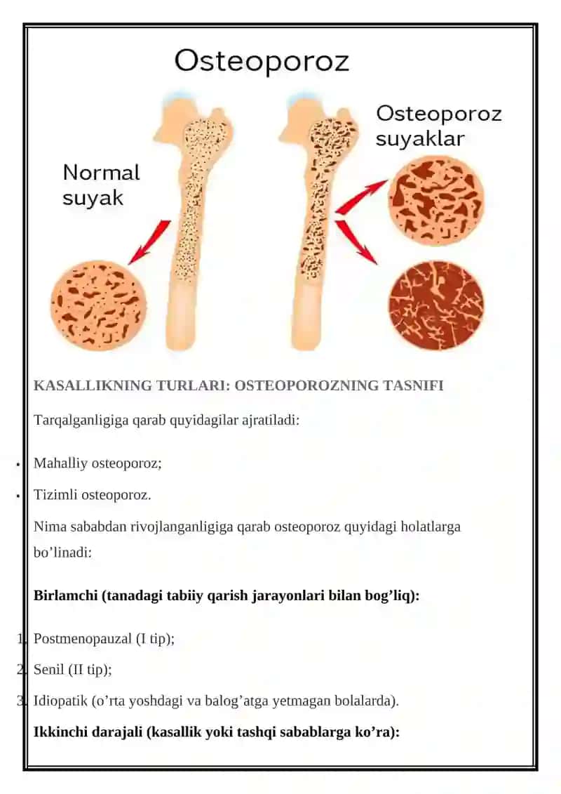 Osteoporoz: Rivojlanish Sabablari va Omillari 4