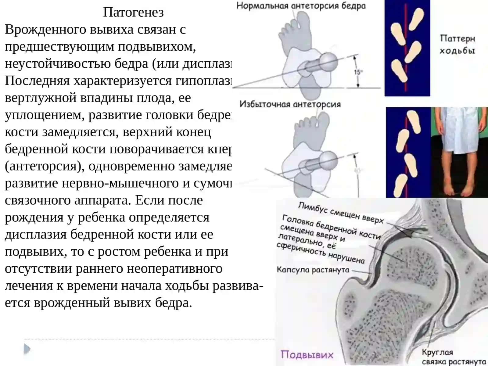 врожденные вывихи бедра косолапость 4