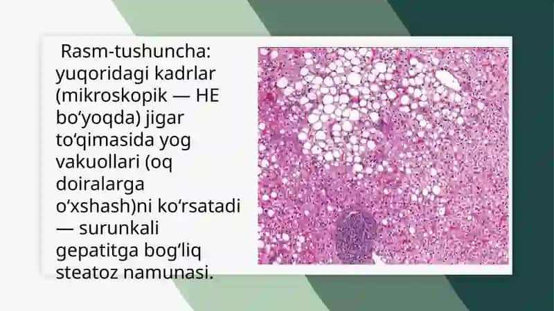 Surunkali gepatitzgarishi.stitlarda  yog‘larning hazimlanishini buzilishi ( steatoriya), yog‘ kislotalarini  va   oksidlanishi , ahamiyati, buzilishlari 4