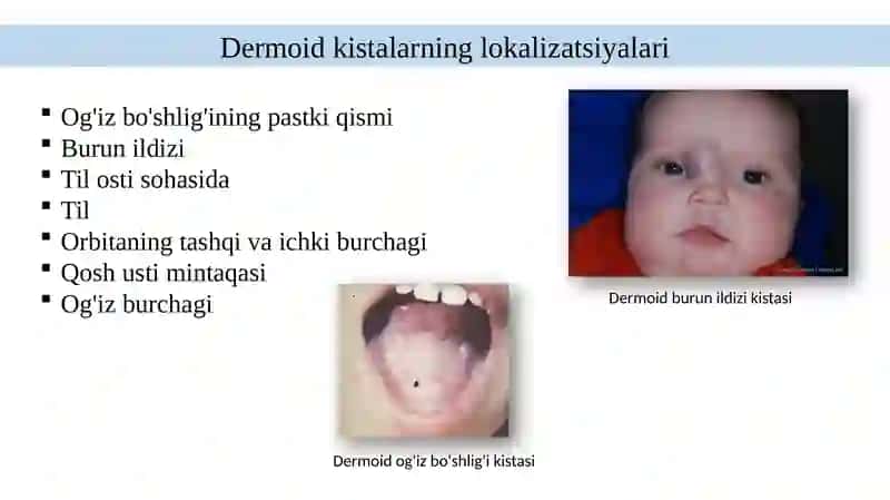 Tug‘ma kistalar (Epidermoid va dermoid kistalar) 4