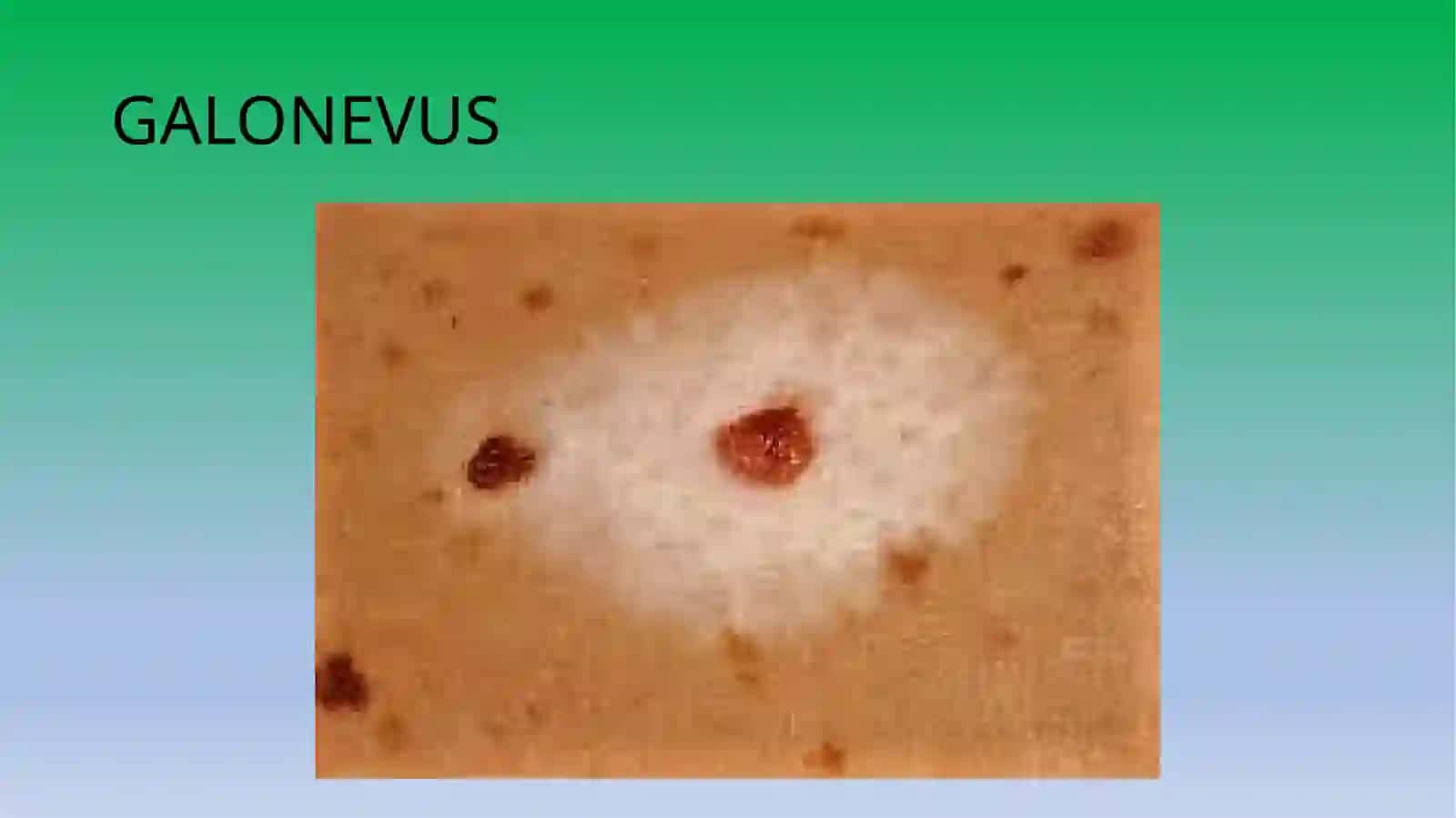 Chegaradagi nevus 4