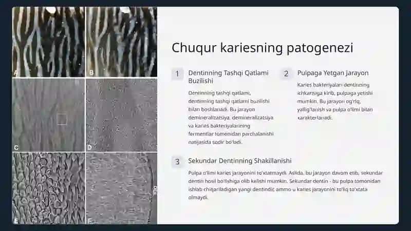 Karies kasalligi va uning tasnifi 4