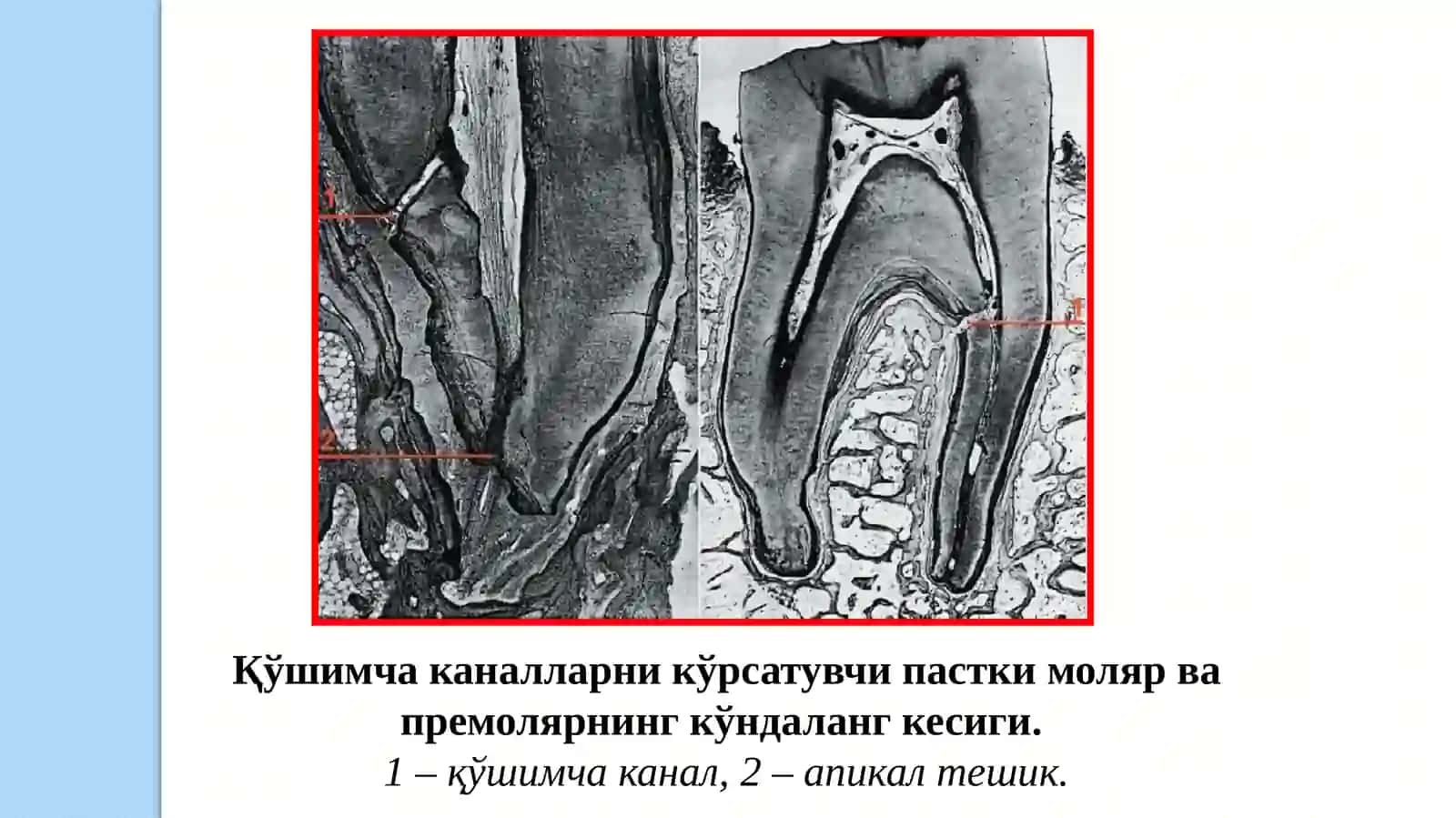 Пульпитлар. Таснифи. Этиология. Патогенез 4