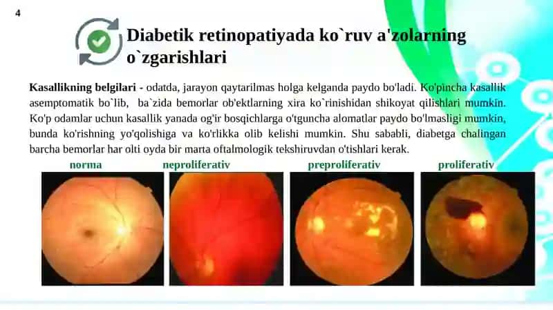 Umumiy kasalliklarda ko`z tubinio`zgarishi 4