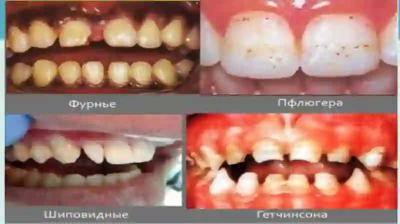 Tish qatorlari qisman nuqsonlarining Gavrilov,Engel va Oksman bo'yicha tasnifi 4