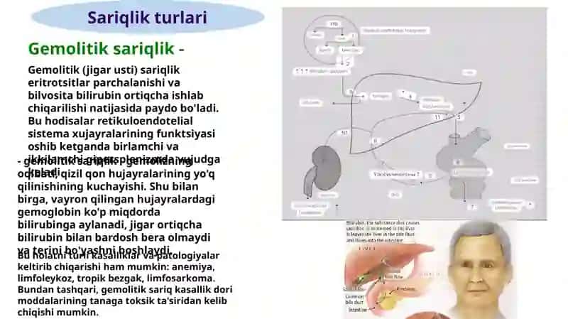 Sariqlik sindromlari 4