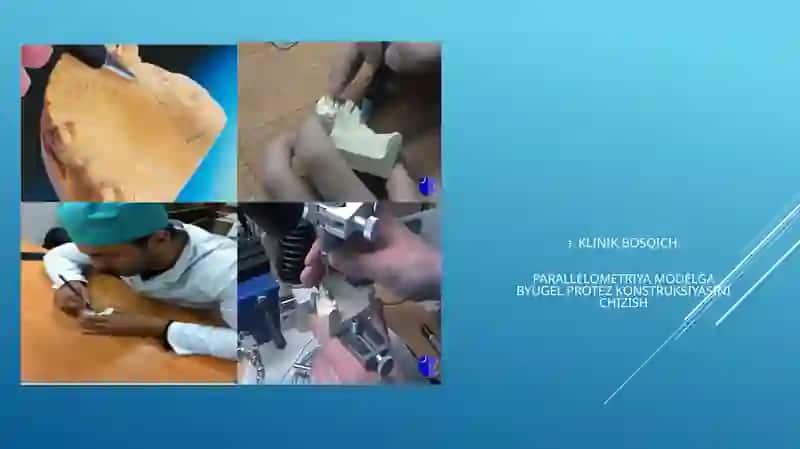 Byugel protezini tayyorlashning klinik-laborator bosqichlari 4