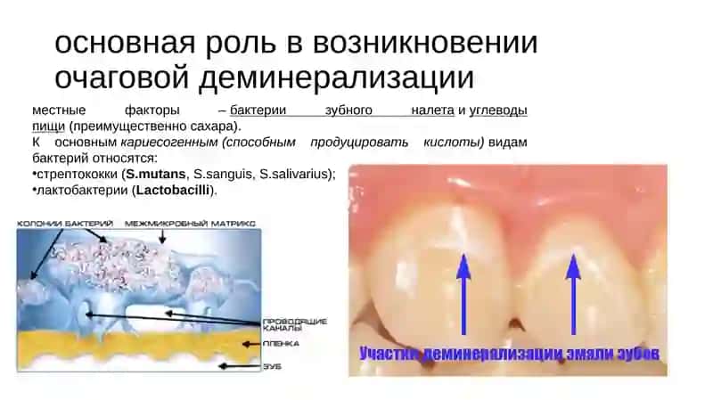 Методы клинической диагностики очаговой деминерализации эмали 4