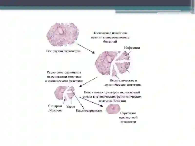 Саркоидоз легких 4
