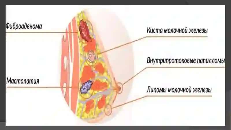 Sut bezining xavfsiz o’smalari. Bachadon,  qin, bachadon bo’yni, vulva neoplaziyalari 4