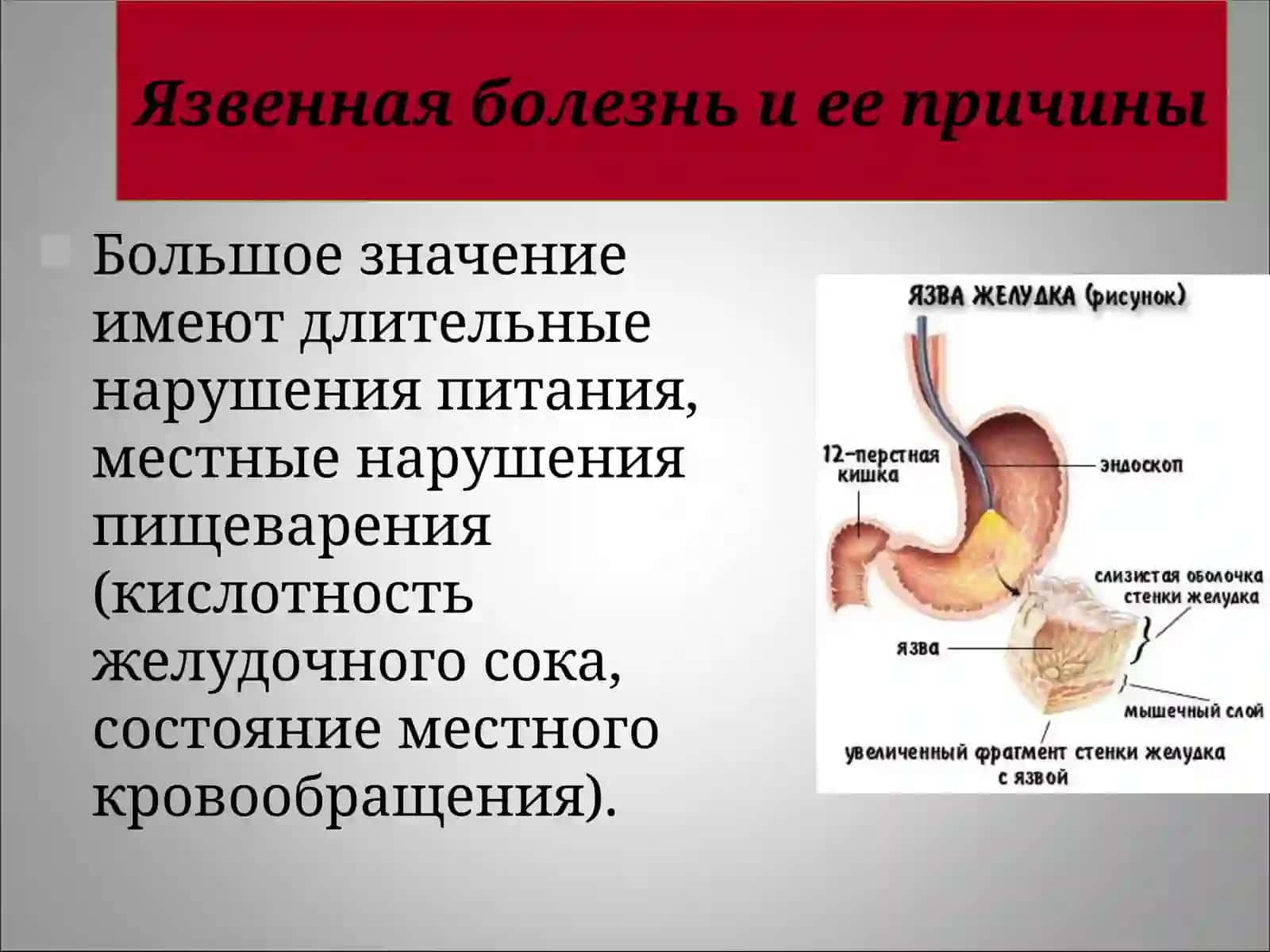 Язвенная болезньжелудка и двенадцатиперстной кишки 4