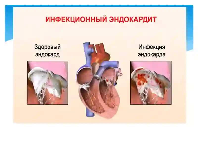 InfeksionendokarditDiagnostikasidavolashi 4