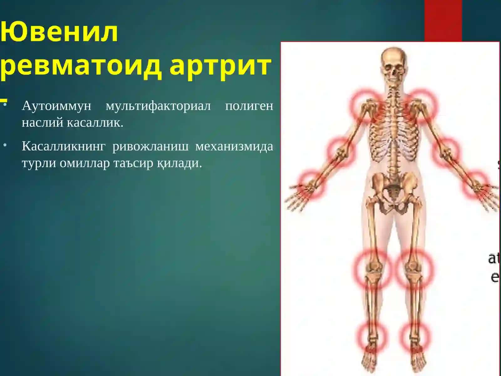 Yuvenil revmatoid artrit 4