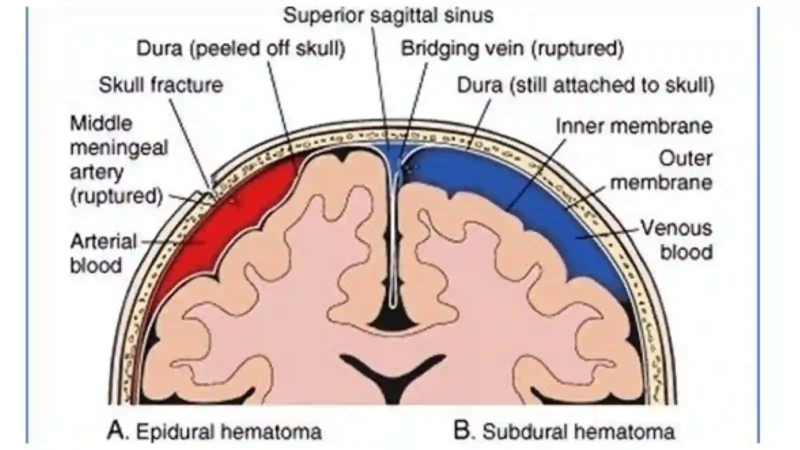 Epidural va Subdural Gematomalar: Solishtirma Tahlil 4