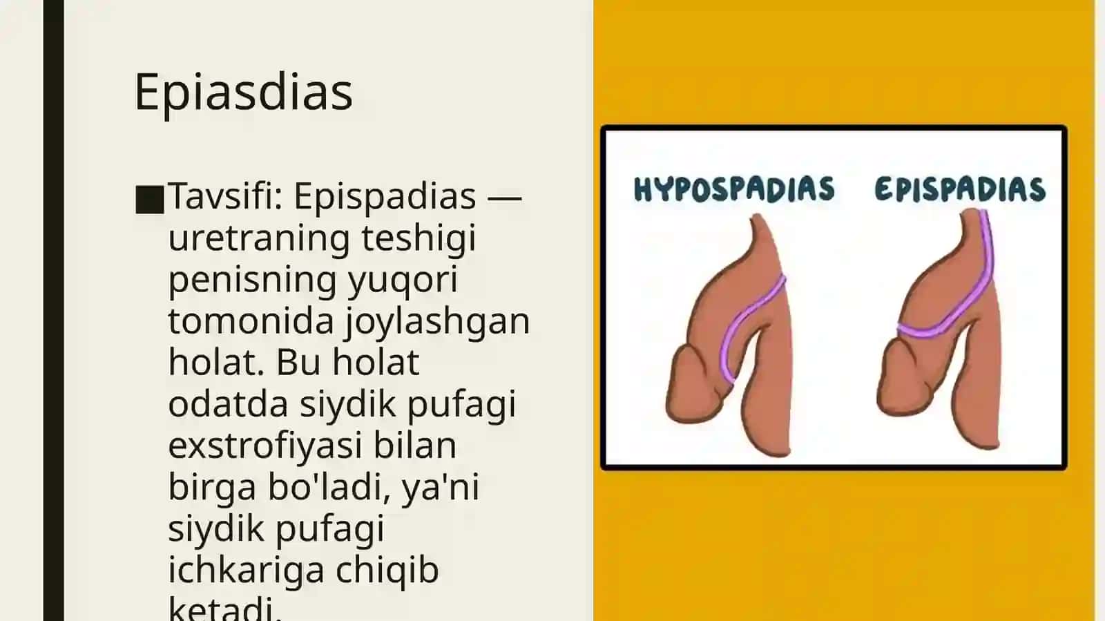Uretra va moyaklar tug'ma nuqsonlari 4
