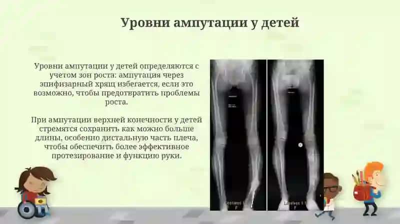 Особенности ампутации у детей 4