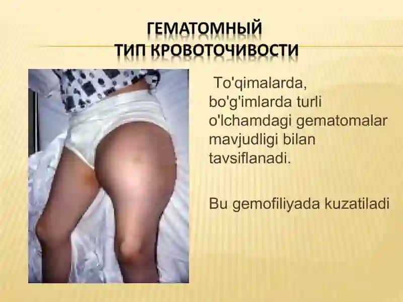 TROMBOCITOPENIYALAR VA GEMOFILIYA 4