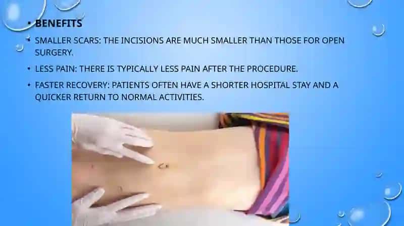 Laparoscopic Surgery. Laparoscopic Splenectomy. Surgery of the Pancreas. Biliodigestive Anastomose 4