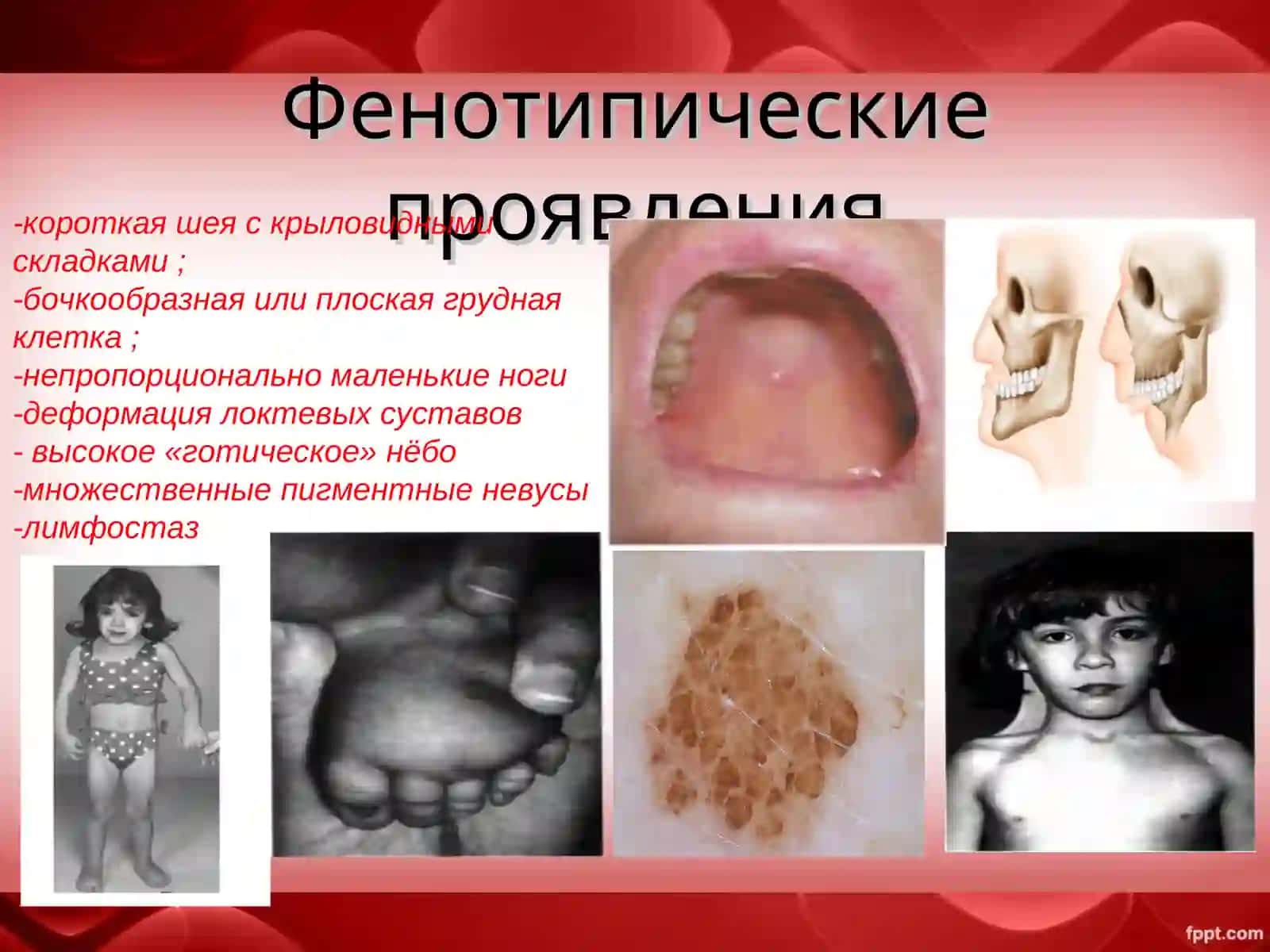 Синдром Шерешевского-Тернера 4
