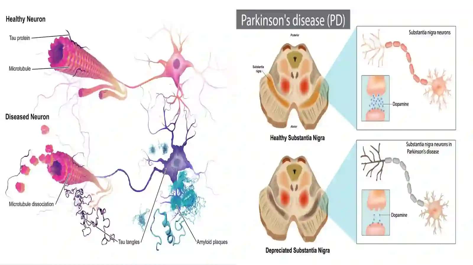 Neyrodegenerativ kasalliklar: Alzgeymer, Parkinsonizm va Gantington xoreyasi 4