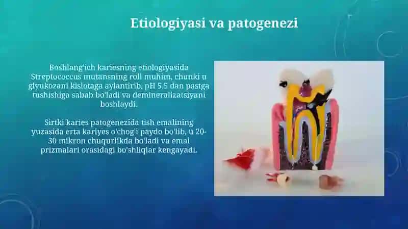 Karies bosqichlari. Boshlangʻich va yuza karies 4