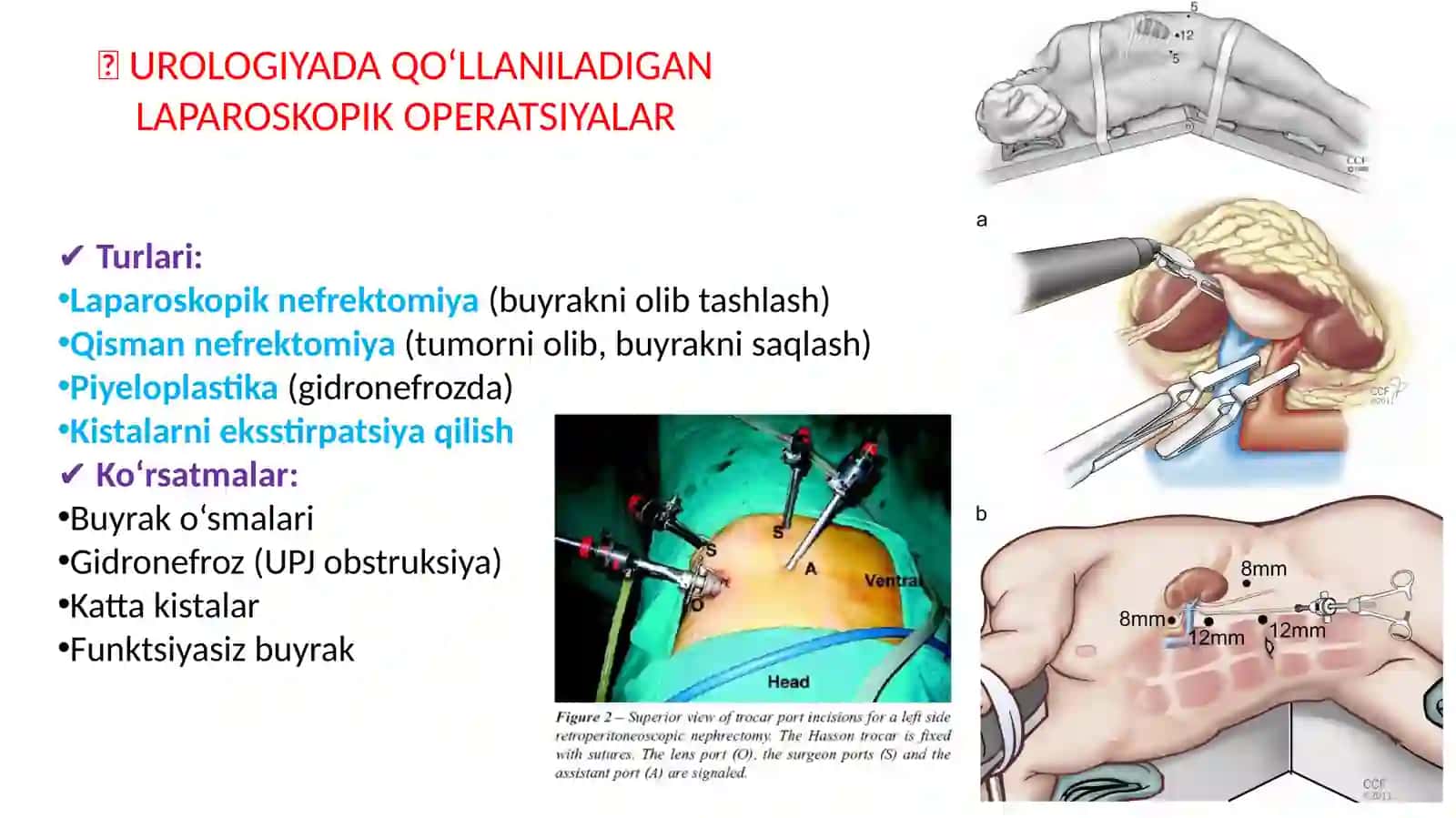 UROLOGIYADA LAPAROSKOPIK OPERATSIYALAR 4