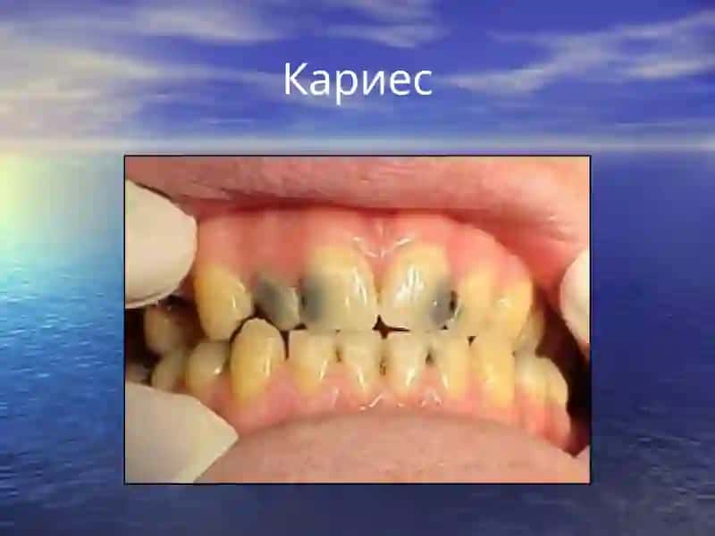 Болаларда тишлар кариеси. Этиологияси, патогенези, таснифи. Болалар ёшида кариес касаллиги кечишининг ўзига хос хусусиятлари ва даволаш йўллари 4