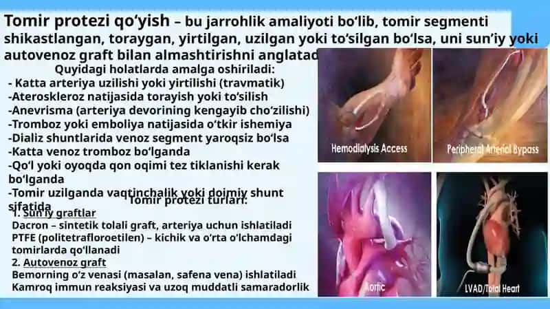 Qo‘l va oyoq qon tomirlarda bajariladigan zamonaviy rekonstruktiv operatsiyalar turlari va texnikasi 4