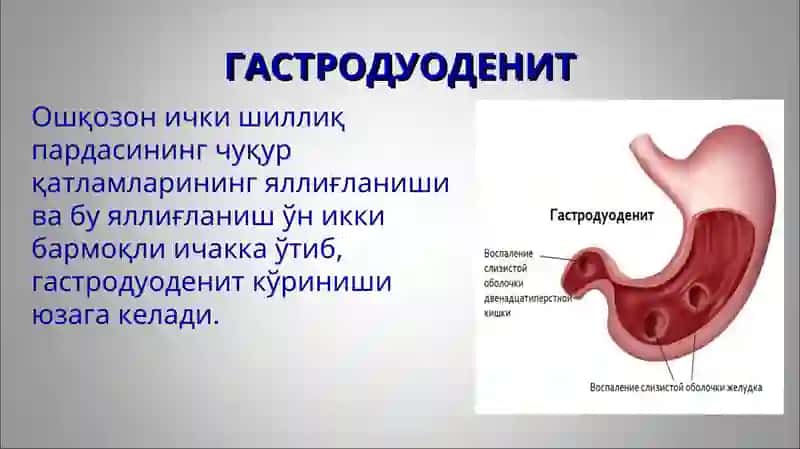 Гастрит ва гастродуоденитларнинг этиологияси, ташхисоти, клиник белгилари ва даволаш 4