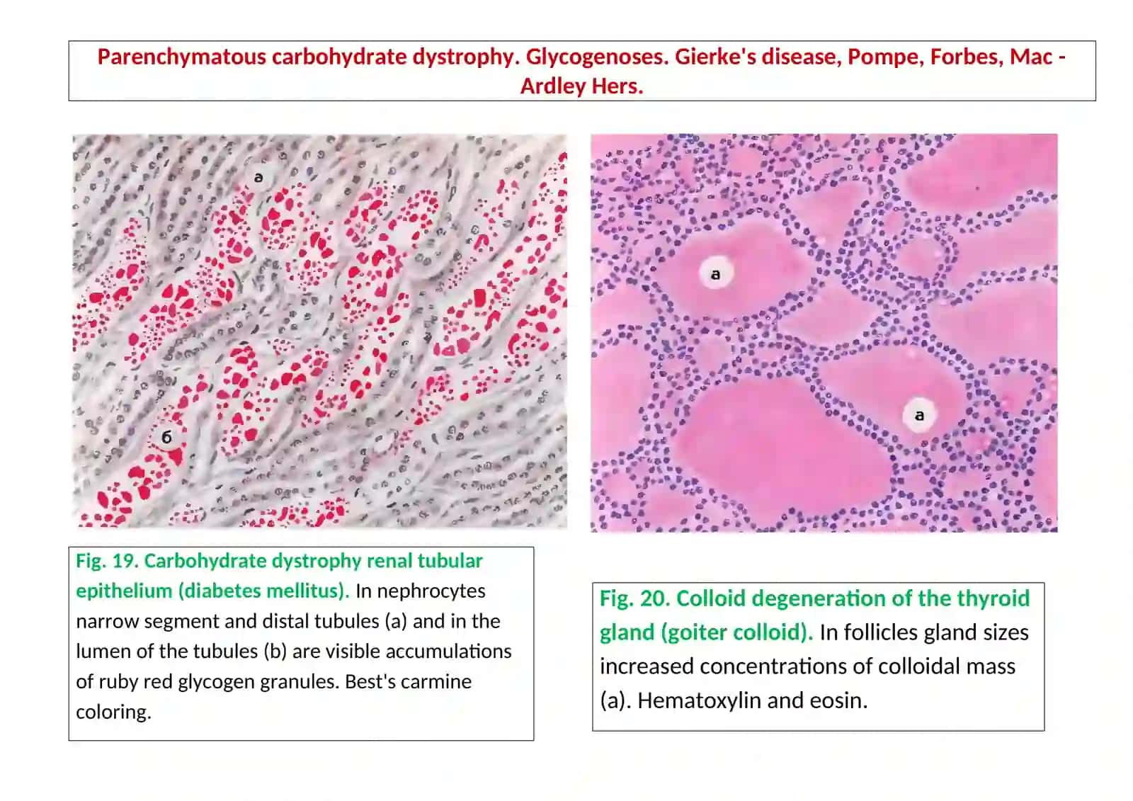 Hydropic dystrophy of epidermis 4