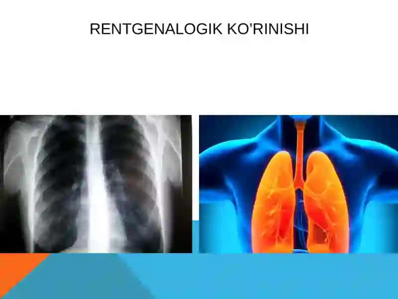 Surunkali pnevmoniya 4