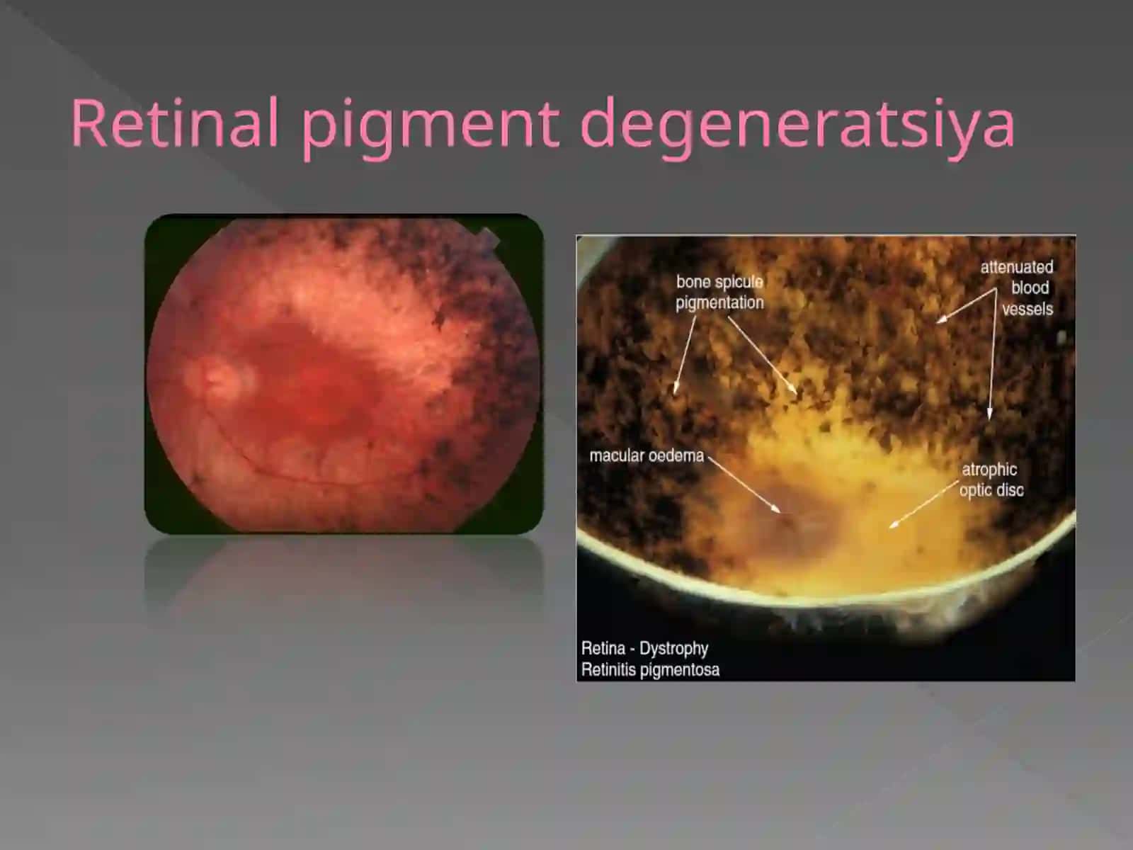 Retinal pigment degeneratsiyasi 4