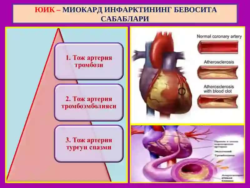 Юрак ишемик касаллиги. Ревматик  касаллик 4