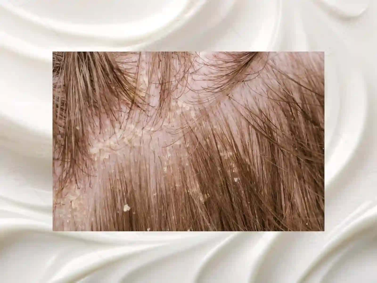 Dermatovenerologiya fanidan Seboreya va Pushti rangli xusn buzargalarning davolash usullari 4