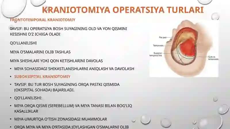 Kraniotomiya 4