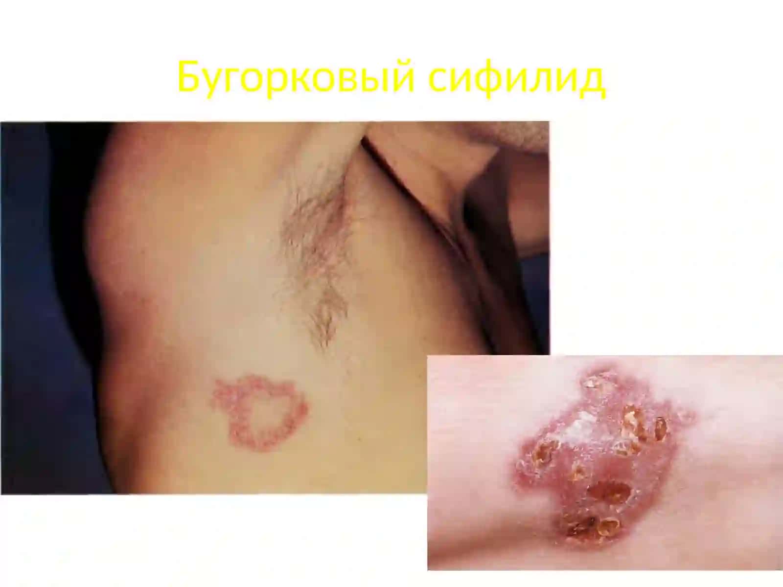 Условия развития третичного сифилиса 4