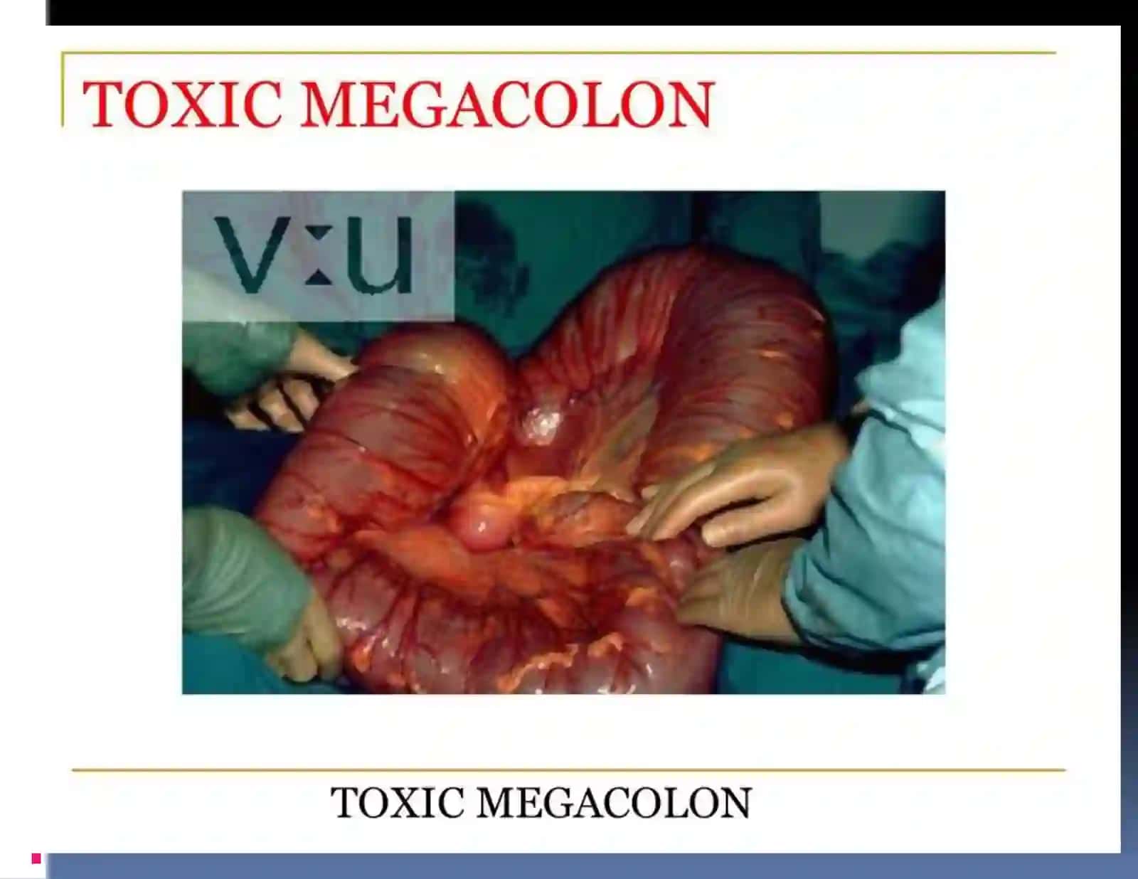 Megakolon 4