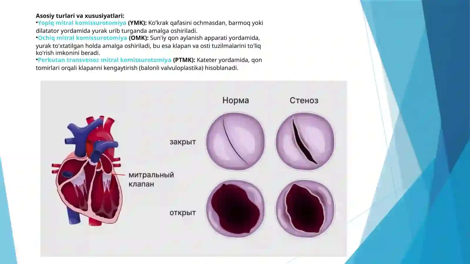 Mitral komissurotomiya va Batalov yo‘lini bog‘lashMitral stenoz operatsiyasiOchiq arteriyal kanal (ductus arteriosus) 4