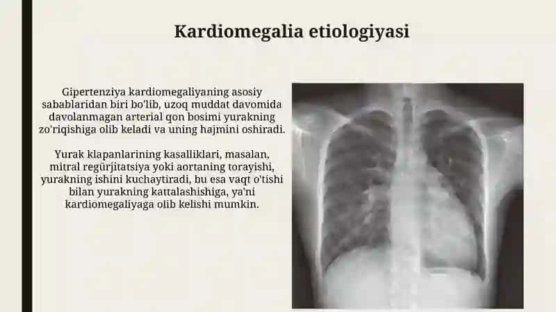 Kardiomegalia: Ta'rif, Etiologiya va Patofiziologiya 4