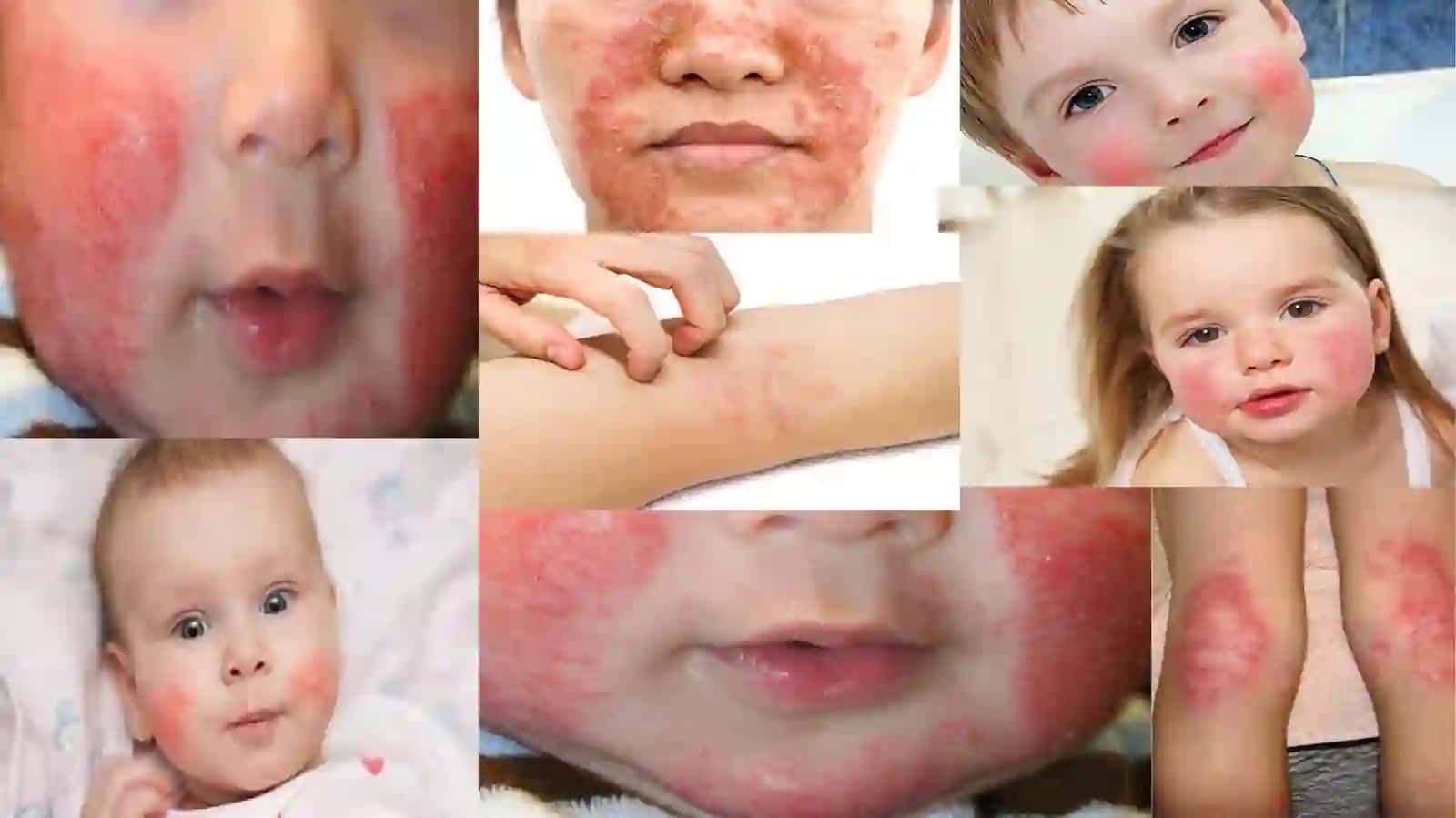 Bolalarda atopik dermatit 4