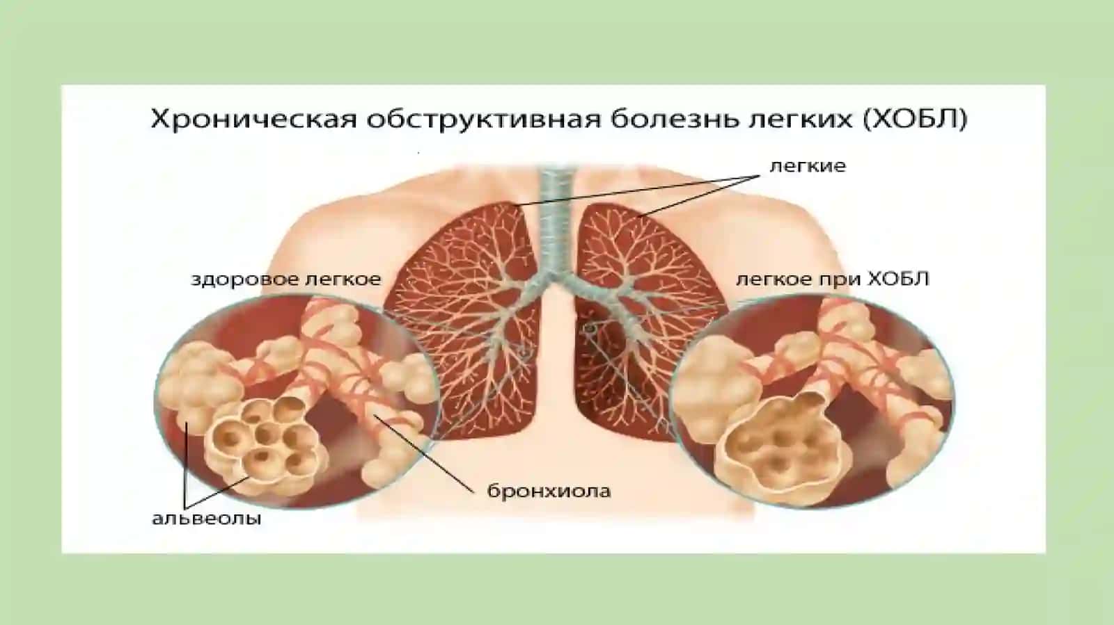 Дыхательная недостаточность 4