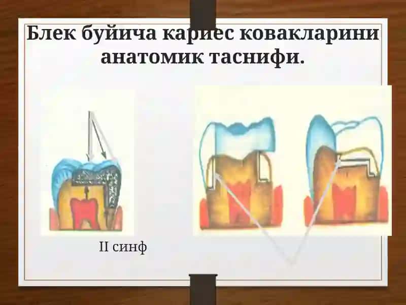 Кариес ковакни чархлаш босқичларивауслублари 4