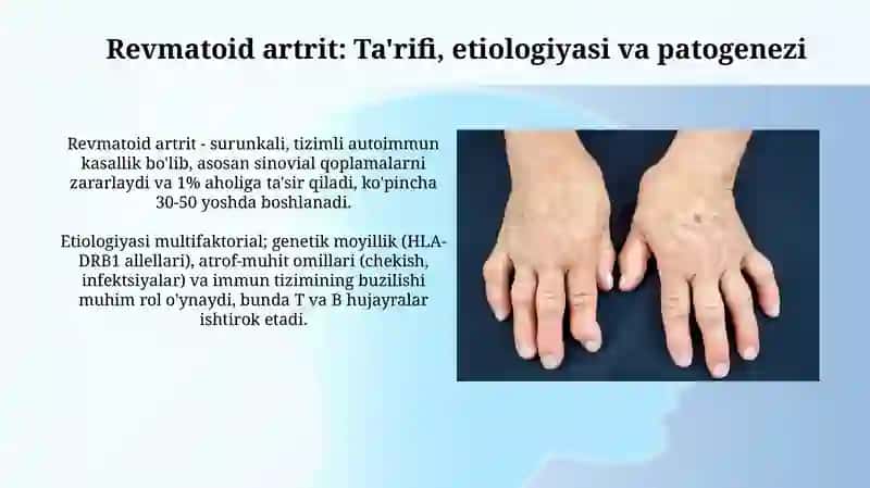 Revmatizm va revmatoid artrit. Seronegativ spondiloartritlarning diagnostik mezonlari 4