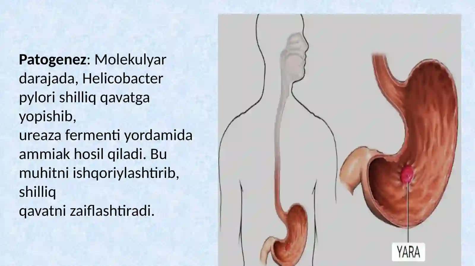Me'da yara kasalligi etiologiyasi, patogenezi, klinikasi asoratlari, davolash usullari 4