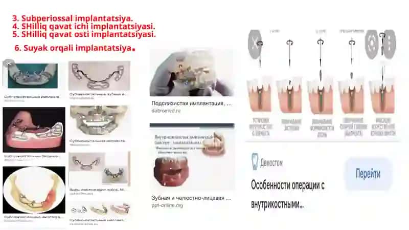 IMPLANTANTLAR TASNIFI 4