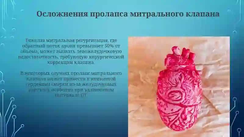 Пролапс митрального клапана 4