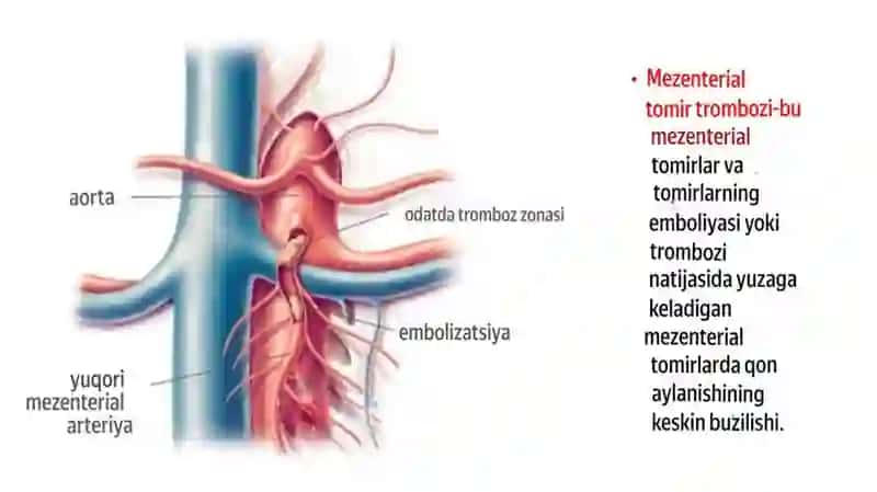Mezenterial tromboz 4